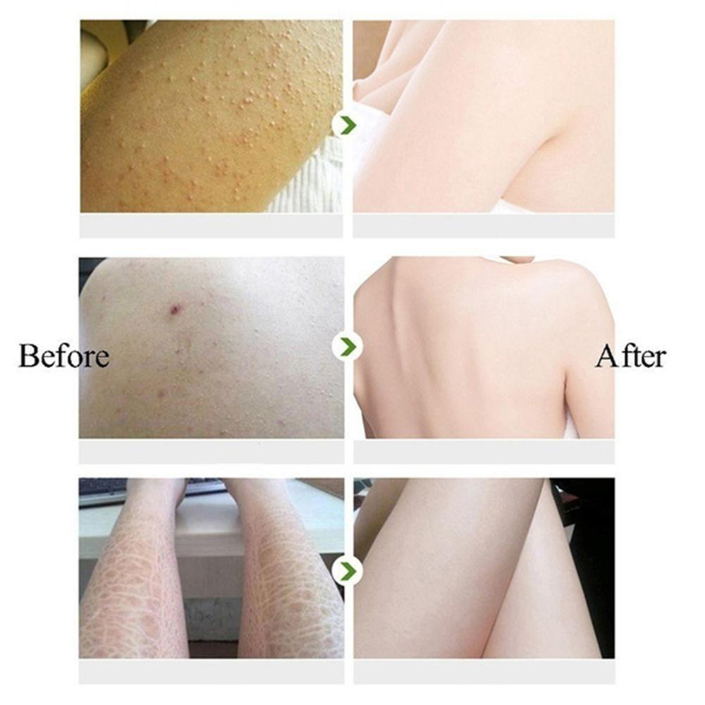 Keratosis Pilaris Behandlung H – Perfume Zara Bewertung und Preis