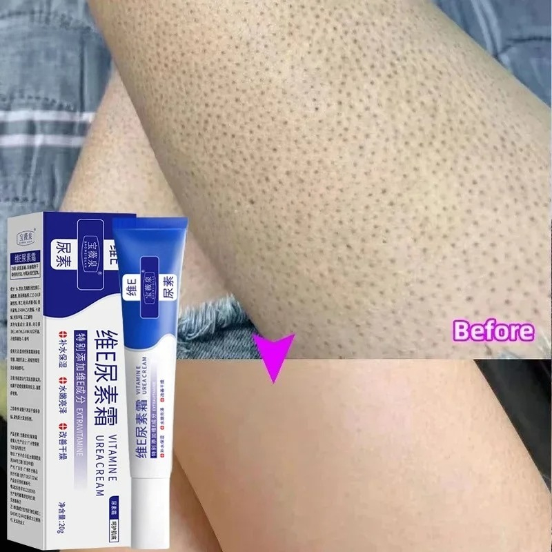 Keratosis Pilaris Behandlung H – Perfume Zara Bewertung und Preis