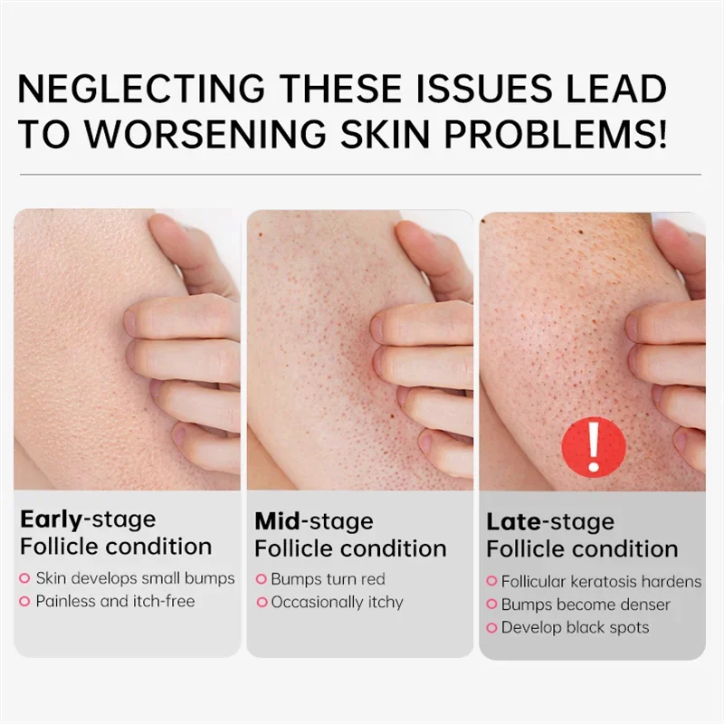 Keratosis Pilaris Behandlung H – Perfume Zara Bewertung und Preis